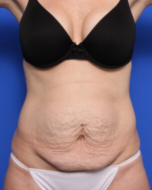 Case # 69 before photo