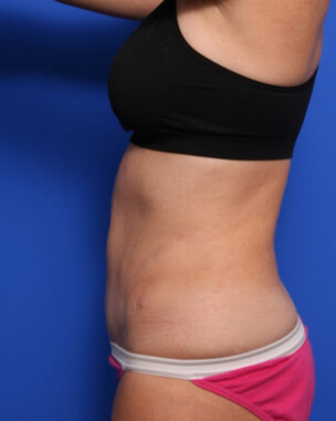 Case # 69 after photo