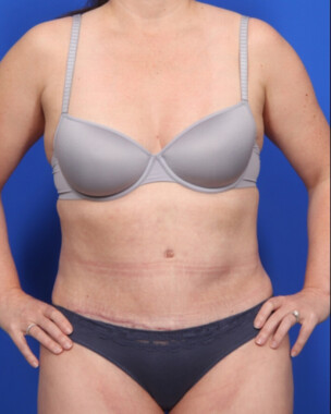 Case # 70 after photo