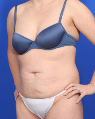 Case # 70 before photo