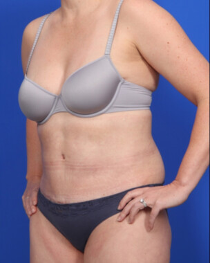 Case # 70 after photo