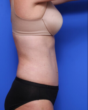 Case # 71 after photo