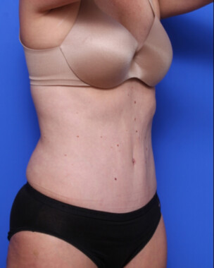 Case # 71 after photo