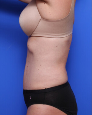 Case # 71 after photo