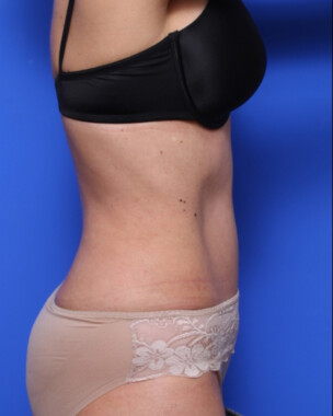 Case # 72 after photo