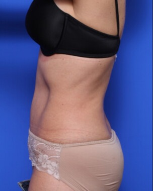 Case # 72 after photo