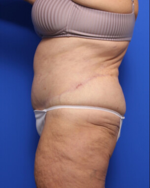 Case # 73 after photo