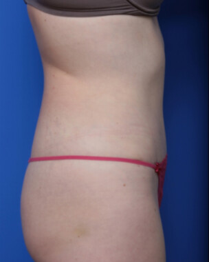 Case # 6 after photo