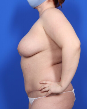 Case # 74 after photo