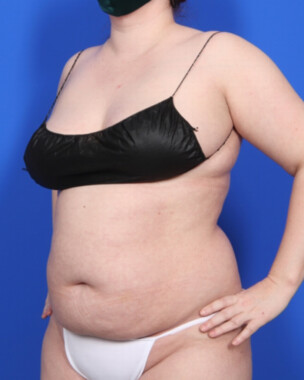 Case # 74 before photo