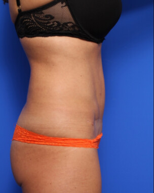 Case # 75 after photo