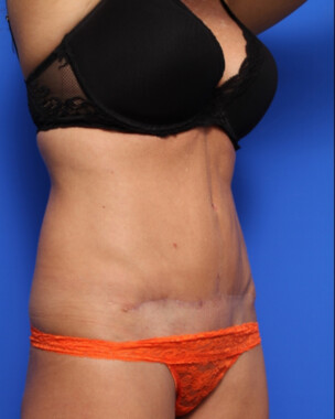 Case # 75 after photo