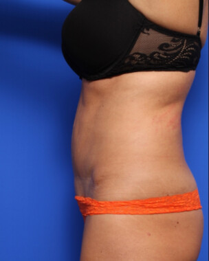 Case # 75 after photo