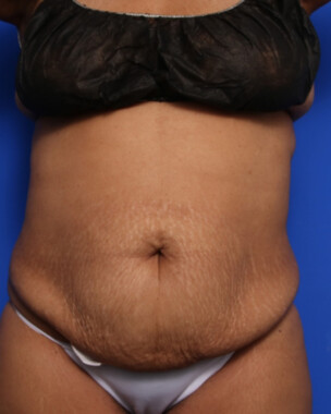 Case # 79 before photo