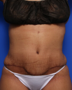 Case # 79 after photo