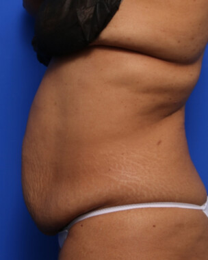 Case # 79 before photo