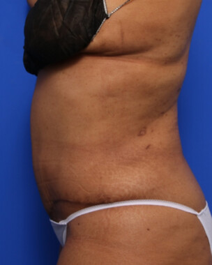 Case # 79 after photo