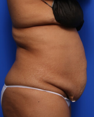 Case # 79 before photo