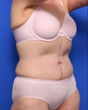 Case # 3 after photo