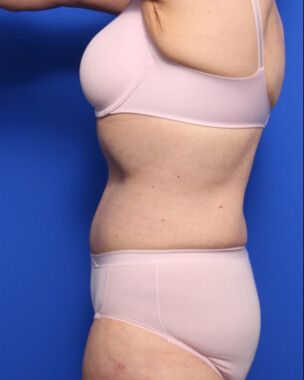 Case # 3 after photo