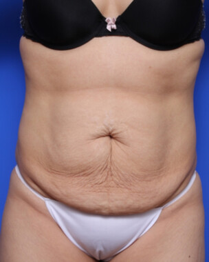 Case # 96 before photo