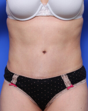 Case # 96 after photo