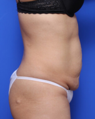 Case # 96 before photo