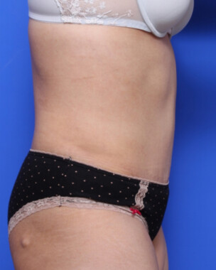 Case # 96 after photo