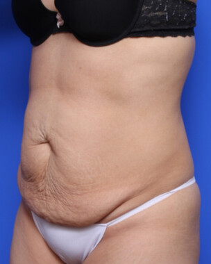 Case # 96 before photo