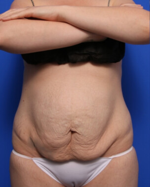 Case # 97 before photo