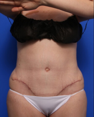 Case # 97 after photo