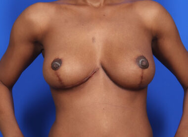 Case # 31 after photo