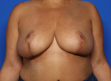 Case # 33 before photo