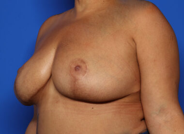 Case # 33 before photo