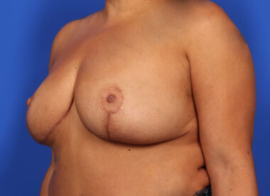 Case # 33 after photo