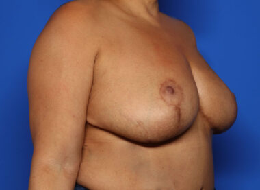 Case # 33 before photo