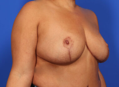 Case # 33 after photo