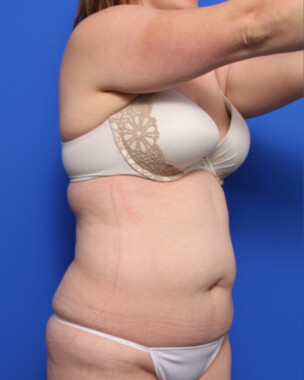 Case # 105 before photo