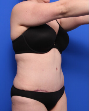 Case # 105 after photo