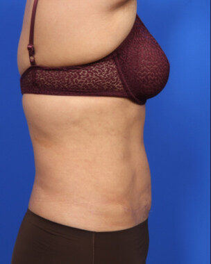 Case # 107 after photo