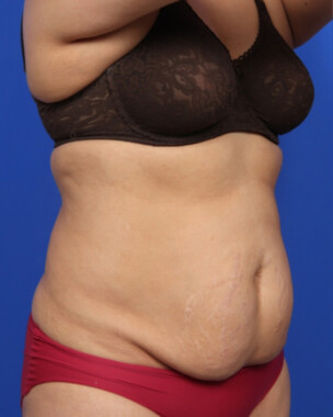 Case # 107 before photo