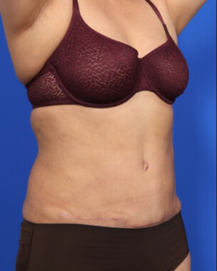 Case # 107 after photo