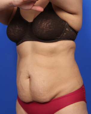 Case # 107 before photo