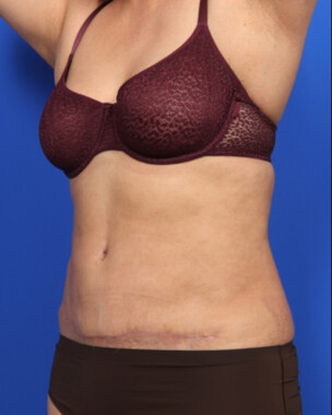 Case # 107 after photo