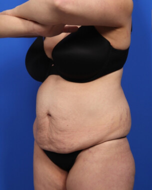 Case # 113 before photo