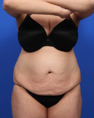 Case # 113 before photo