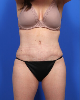 Case # 115 after photo