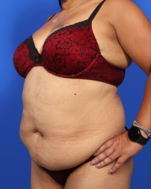 Case # 118 before photo