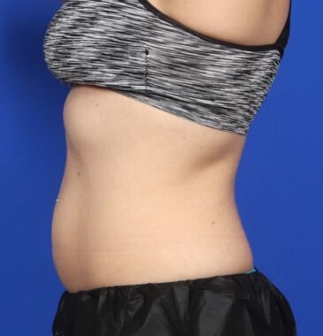 Case # 20 after photo