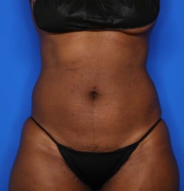 Case # 22 after photo